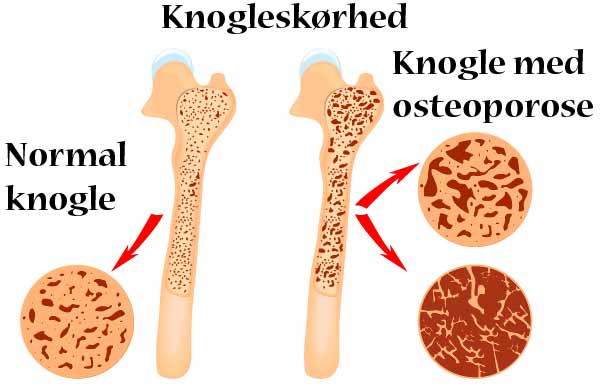 Knogleskørhed er resultatet af at knoglernes struktur opløses pga. blandt kalkmangel.